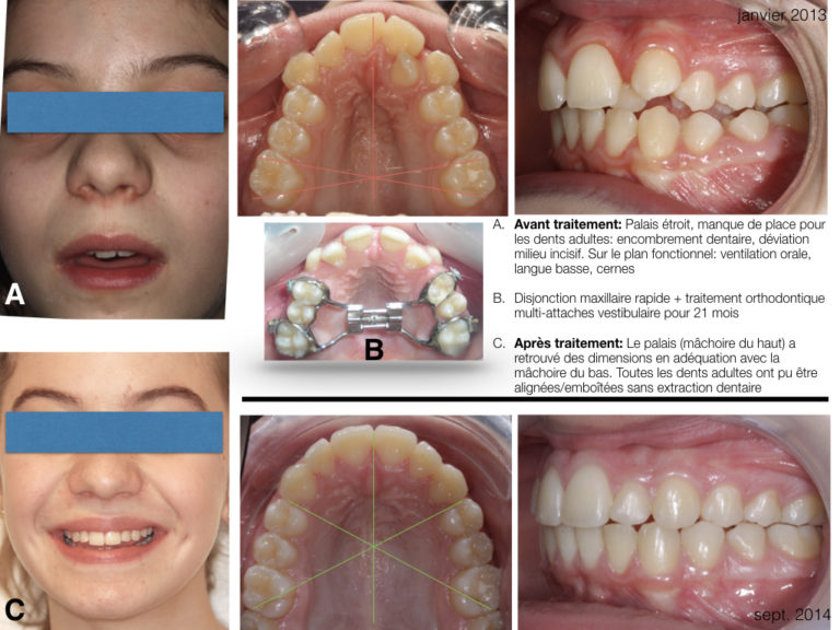 Expansion palatine Orthodontie Lancy